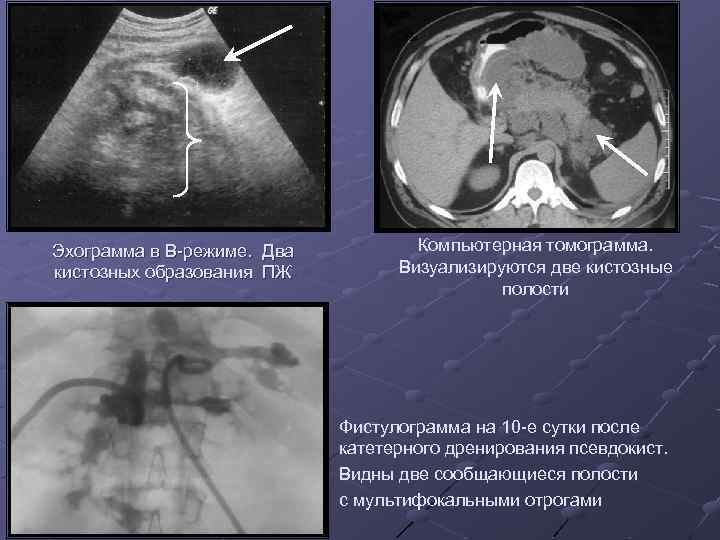 Эхограмма в В-режиме. Два кистозных образования ПЖ Компьютерная томограмма. Визуализируются две кистозные полости Фистулограмма