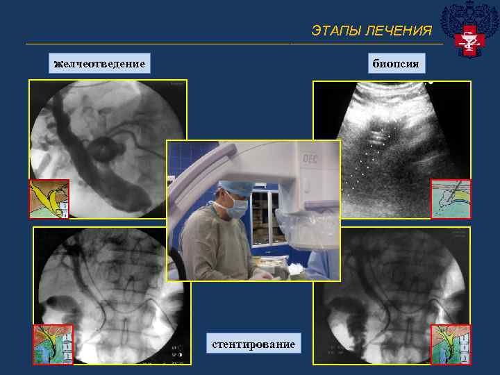 ЭТАПЫ ЛЕЧЕНИЯ ______________________________ желчеотведение биопсия стентирование 