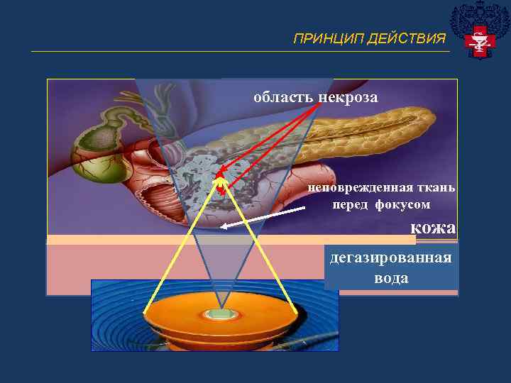 ПРИНЦИП ДЕЙСТВИЯ ______________________________ область некроза неповрежденная ткань перед фокусом кожа дегазированная вода 