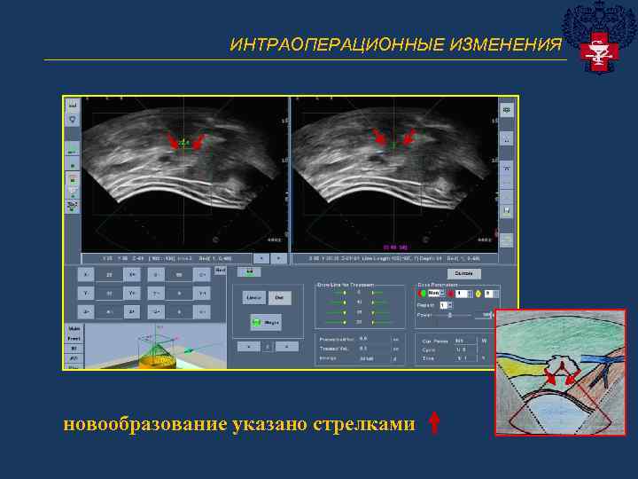 ИНТРАОПЕРАЦИОННЫЕ ИЗМЕНЕНИЯ ______________________________ новообразование указано стрелками 