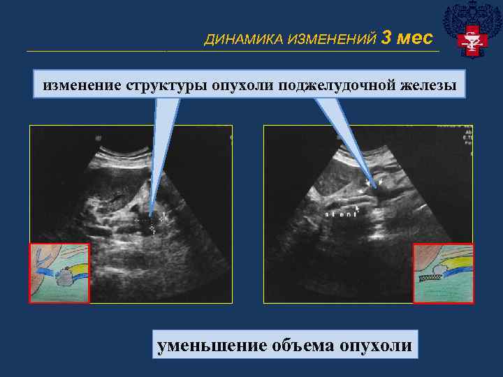 ДИНАМИКА ИЗМЕНЕНИЙ 3 мес ______________________________ изменение структуры опухоли поджелудочной железы уменьшение объема опухоли 