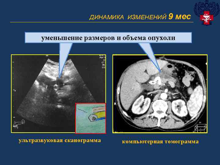ДИНАМИКА ИЗМЕНЕНИЙ 9 мес ______________________________ уменьшение размеров и объема опухоли ультразвуковая сканограмма компьютерная томограмма