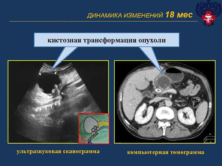 ДИНАМИКА ИЗМЕНЕНИЙ 18 мес _______________________________ кистозная трансформация опухоли ультразвуковая сканограмма компьютерная томограмма 