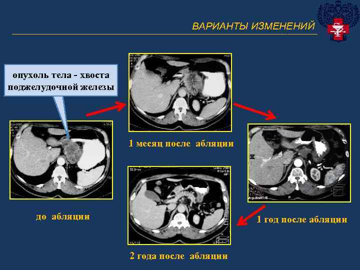 ВАРИАНТЫ ИЗМЕНЕНИЙ _______________________________ опухоль тела - хвоста поджелудочной железы 1 месяц после абляции до