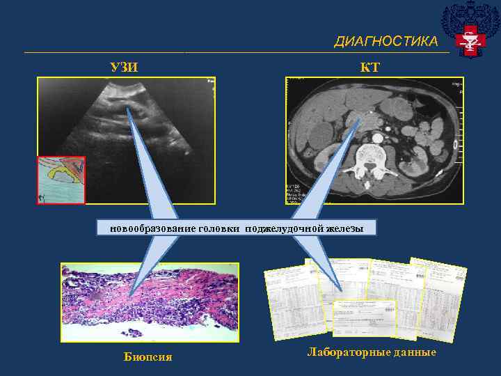 ДИАГНОСТИКА _______________________________ УЗИ КТ новообразование головки поджелудочной железы Биопсия Лабораторные данные 
