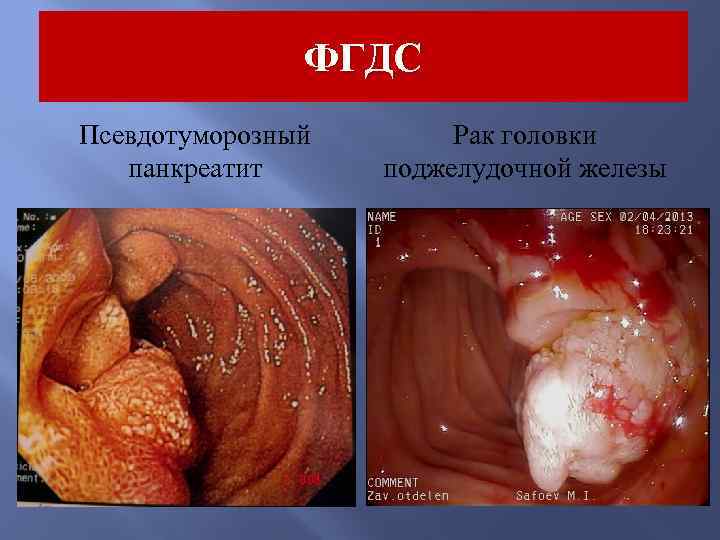 ФГДС Псевдотуморозный панкреатит Рак головки поджелудочной железы 