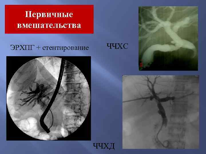 Первичные вмешательства ЭРХПГ + стентирование ЧЧХС ЧЧХД 