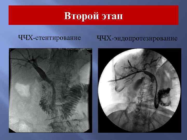 Второй этап ЧЧХ-стентирование ЧЧХ-эндопротезирование 