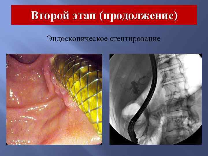 Второй этап (продолжение) Эндоскопическое стентирование 