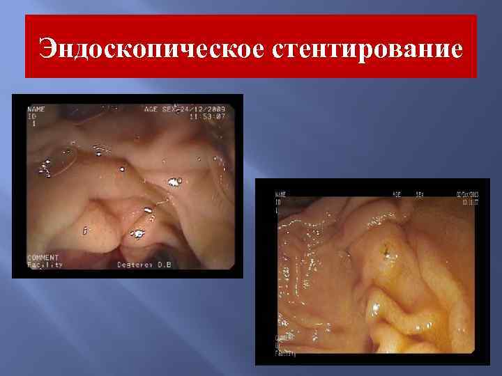 Эндоскопическое стентирование 