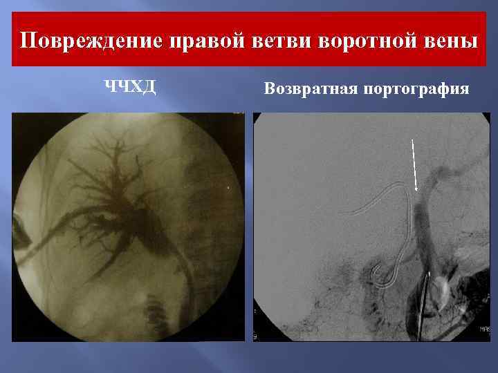 Повреждение правой ветви воротной вены ЧЧХД Возвратная портография 