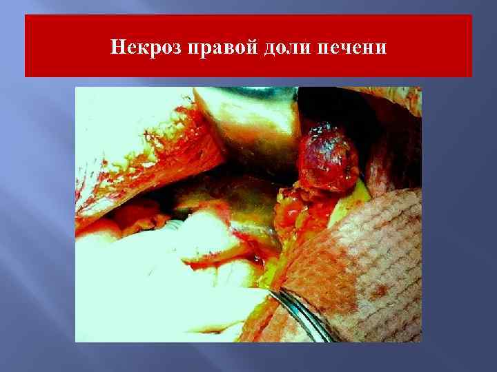 Некроз правой доли печени 