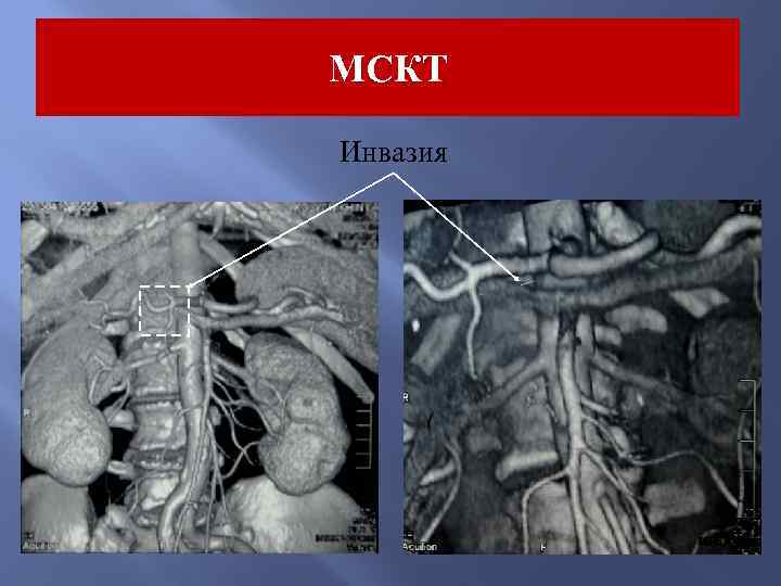 МСКТ Инвазия 