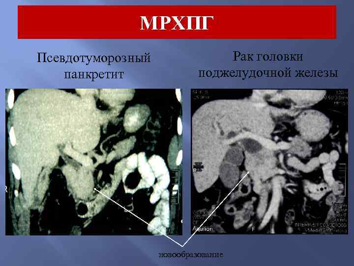 МРХПГ Псевдотуморозный панкретит Рак головки поджелудочной железы новообразование 
