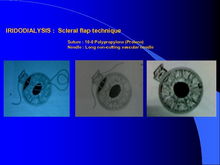 IRIDODIALYSIS : Scleral flap technique Suture : 10 -0 Polypropylene (Prolene) Needle : Long