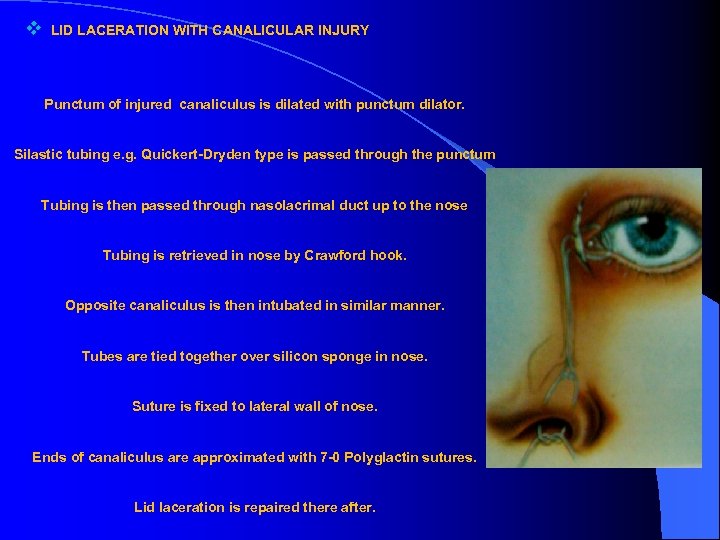 v LID LACERATION WITH CANALICULAR INJURY Punctum of injured canaliculus is dilated with punctum