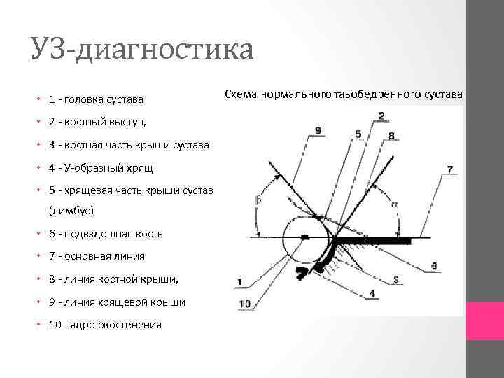 УЗ-диагностика • 1 головка сустава • 2 костный выступ, • 3 костная часть крыши