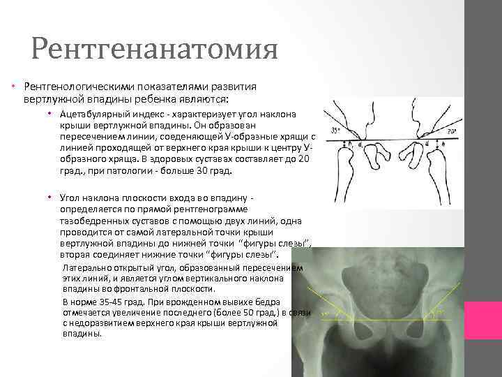 Рентгенанатомия • Рентгенологическими показателями развития вертлужной впадины ребенка являются: • Ацетабулярный индекс характеризует угол