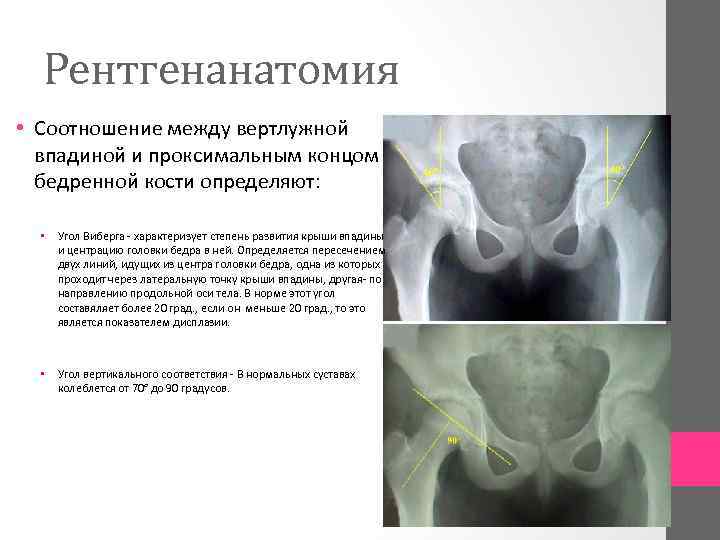 Рентгенанатомия • Соотношение между вертлужной впадиной и проксимальным концом бедренной кости определяют: • Угол