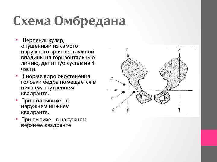 Схема Омбредана • Перпендикуляр, опущенный из самого наружного края вертлужной впадины на горизонтальную линию,