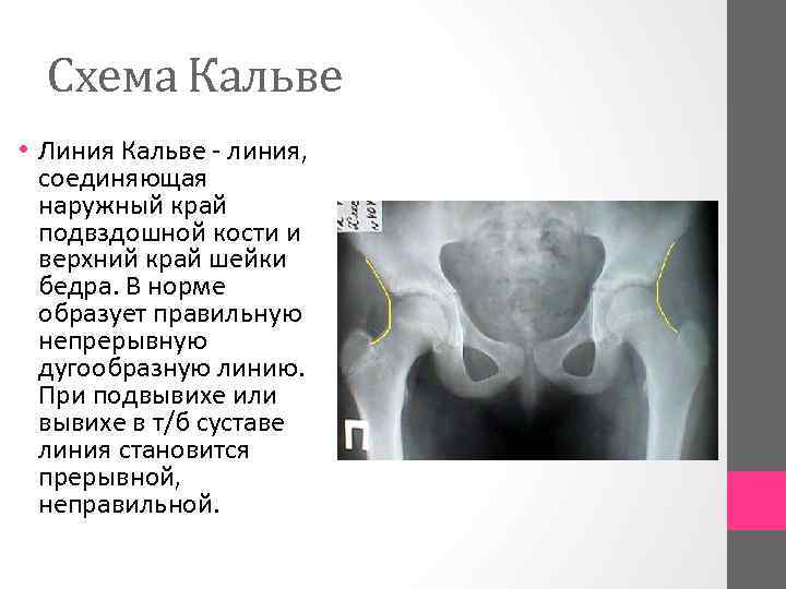 Схема Кальве • Линия Кальве линия, соединяющая наружный край подвздошной кости и верхний край