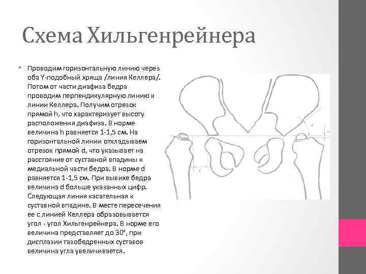 Схема Хильгенрейнера • Проводим горизонтальную линию через оба Y подобный хряща /линия Келлера/. Потом