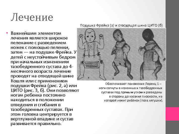 Лечение • Важнейшим элементом лечения является широкое пеленание с разведением ножек с помощью пеленки,