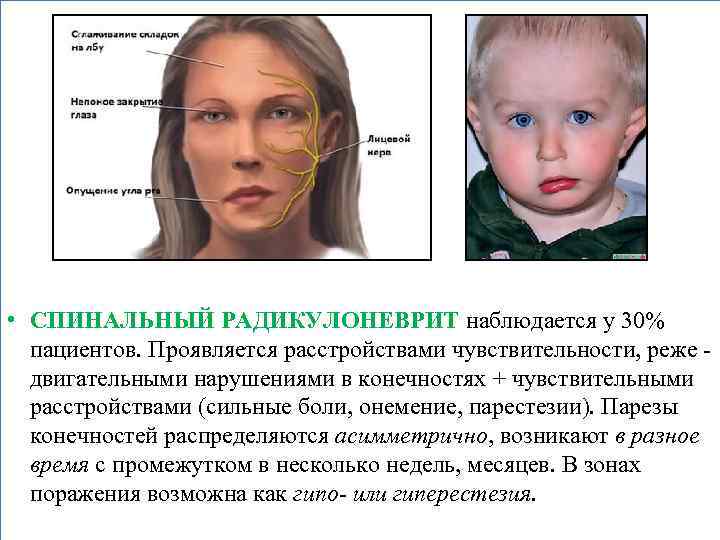  • СПИНАЛЬНЫЙ РАДИКУЛОНЕВРИТ наблюдается у 30% пациентов. Проявляется расстройствами чувствительности, реже двигательными нарушениями