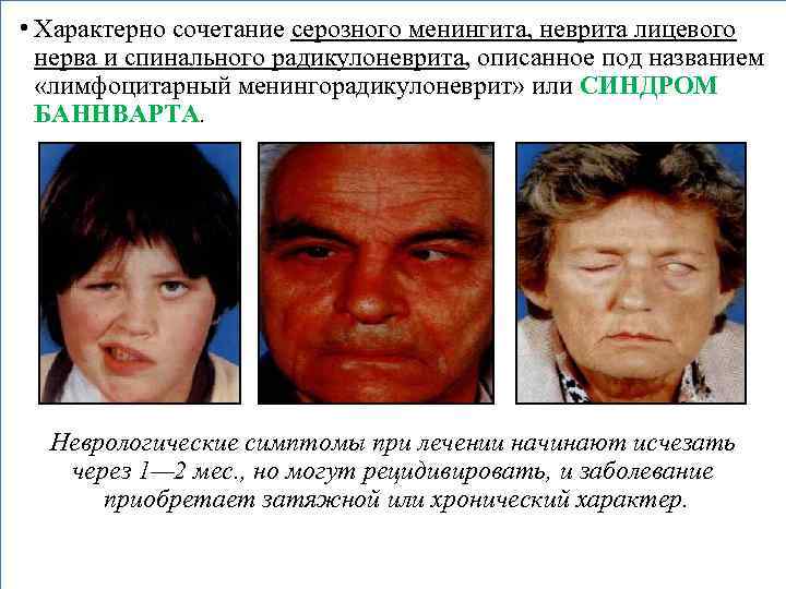  • Характерно сочетание серозного менингита, неврита лицевого нерва и спинального радикулоневрита, описанное под