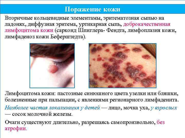 Поражение кожи Вторичные кольцевидные элементамы, эритематозная сыпью на ладонях, диффузная эритема, уртикарная сыпь, доброкачественная