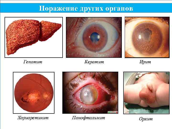 Поражение других органов Гепатит Хориоретинит Кератит Панофтальмит Ирит Орхит 