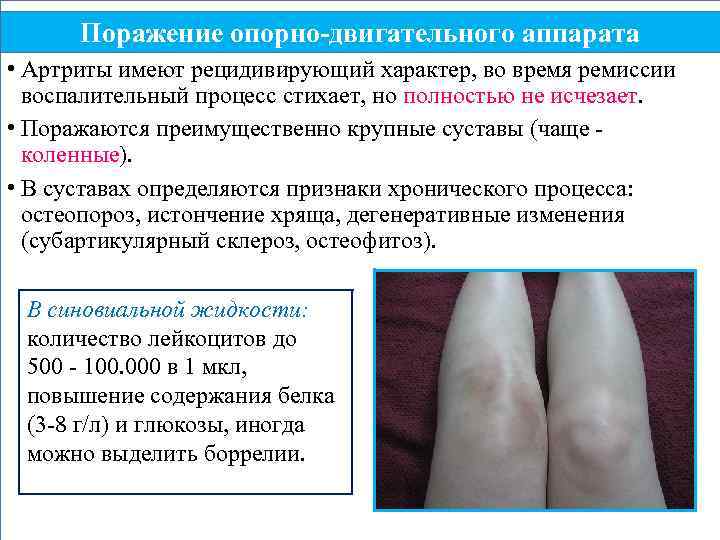 Поражение опорно-двигательного аппарата • Артриты имеют рецидивирующий характер, во время ремиссии воспалительный процесс стихает,