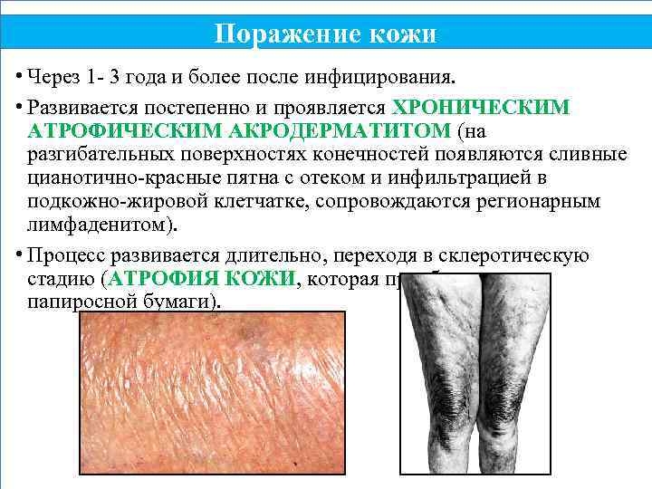 Поражение кожи • Через 1 - 3 года и более после инфицирования. • Развивается
