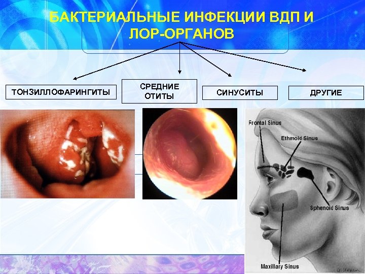 БАКТЕРИАЛЬНЫЕ ИНФЕКЦИИ ВДП И ЛОР-ОРГАНОВ ТОНЗИЛЛОФАРИНГИТЫ СРЕДНИЕ ОТИТЫ СИНУСИТЫ ДРУГИЕ 