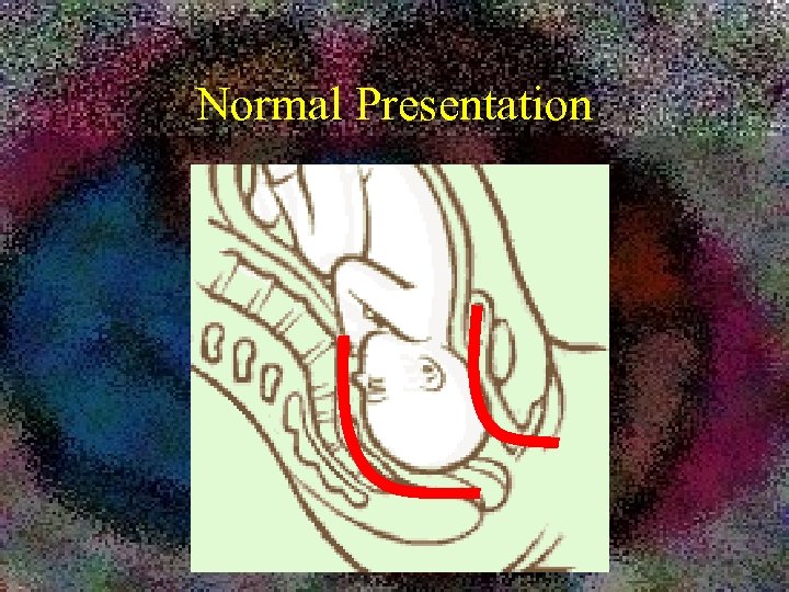 Normal Presentation 