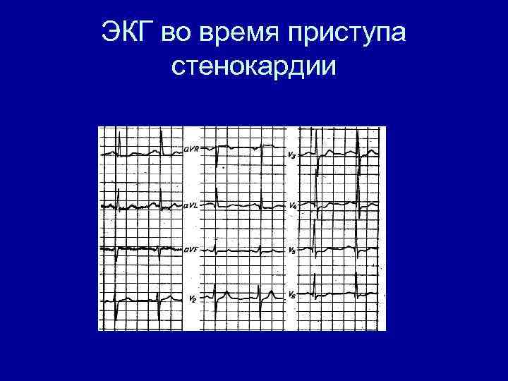 ЭКГ во время приступа стенокардии 