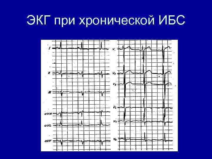 ЭКГ при хронической ИБС 