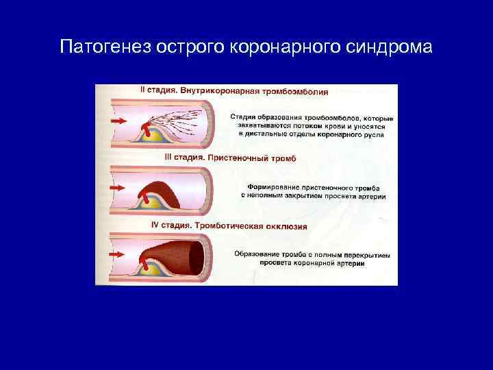 Патогенез острого коронарного синдрома 