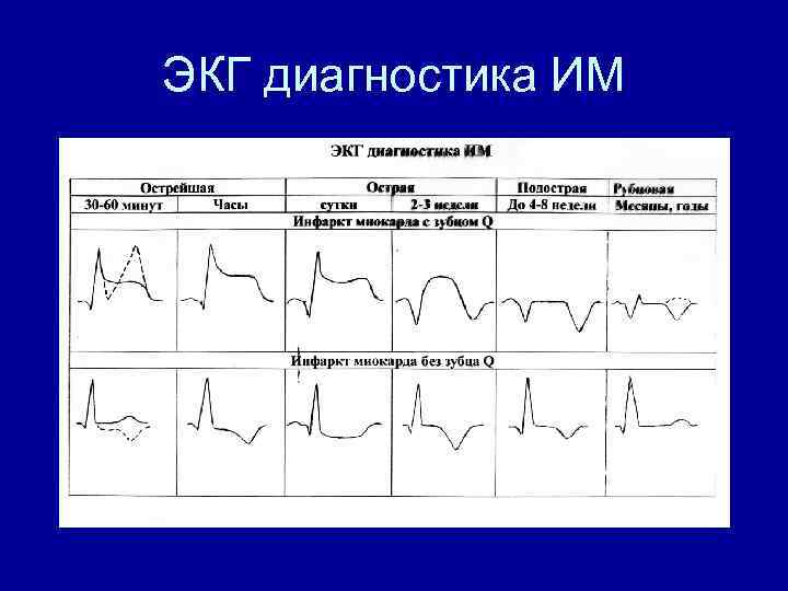 ЭКГ диагностика ИМ 