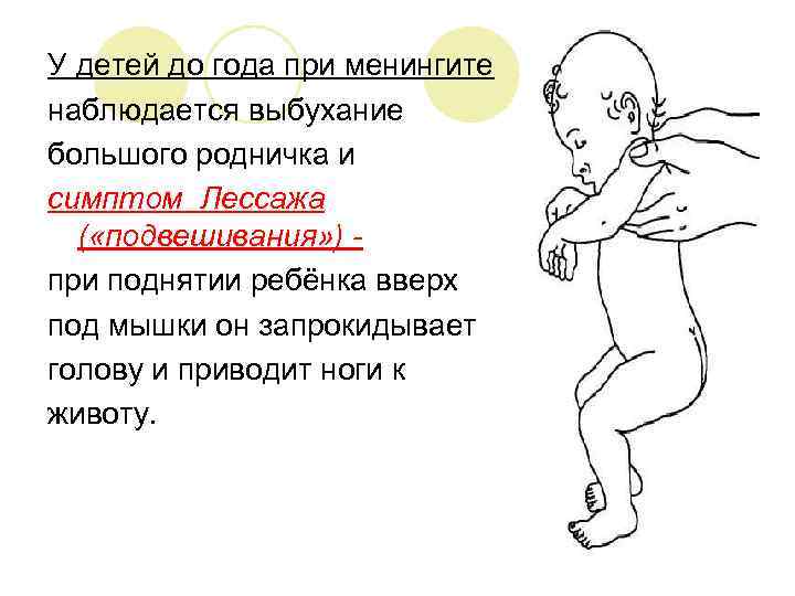 У детей до года при менингите наблюдается выбухание большого родничка и симптом Лессажа (