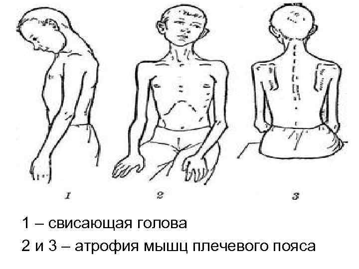 1 – свисающая голова 2 и 3 – атрофия мышц плечевого пояса 