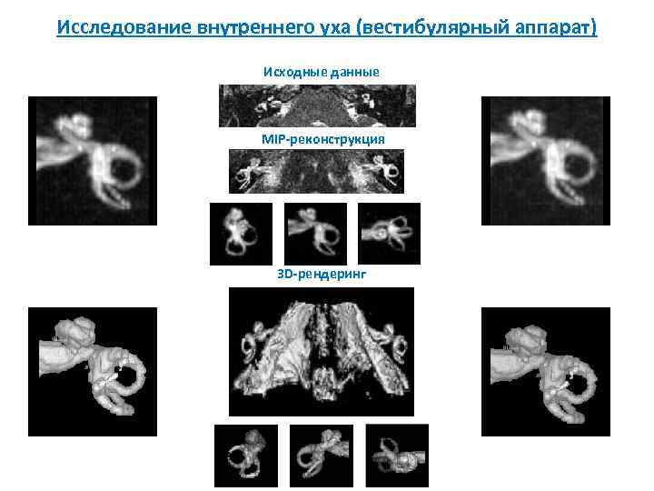 Исследование внутреннего уха (вестибулярный аппарат) Исходные данные MIP-реконструкция 3 D-рендеринг 