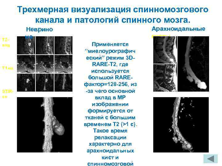 Трехмерная визуализация спинномозгового канала и патологий спинного мозга. Арахноидальные кисты Неврино T 2 sag