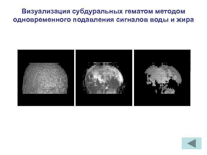 Визуализация субдуральных гематом методом одновременного подавления сигналов воды и жира 
