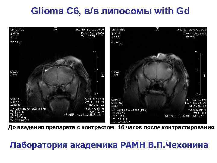 Glioma С 6, в/в липосомы with Gd До введения препарата с контрастом 16 часов