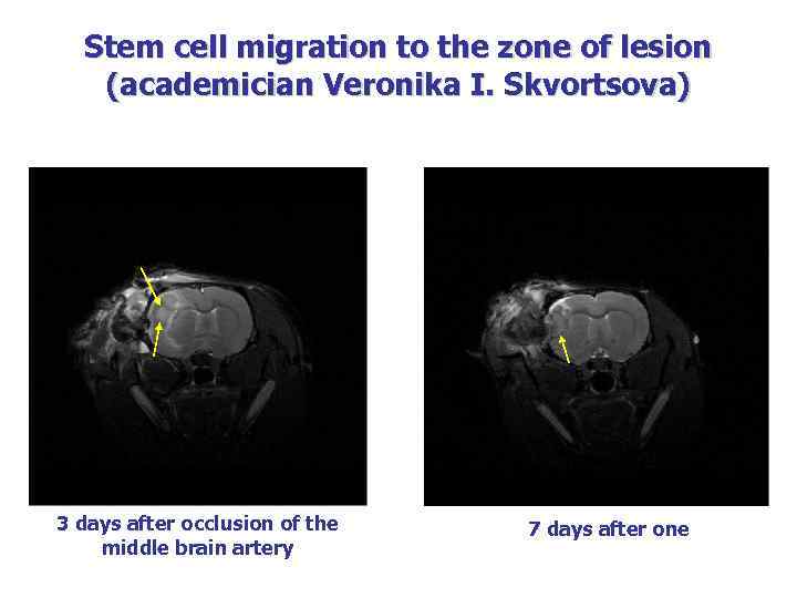Stem cell migration to the zone of lesion (academician Veronika I. Skvortsova) 3 days