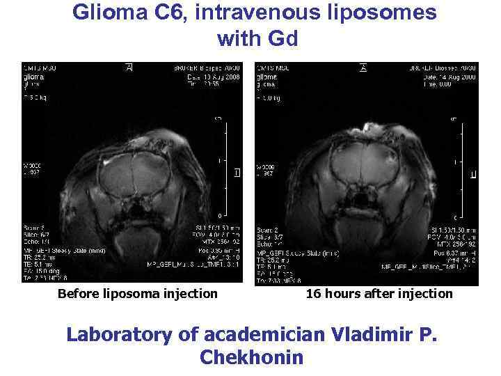 Glioma С 6, intravenous liposomes with Gd Before liposoma injection 16 hours after injection