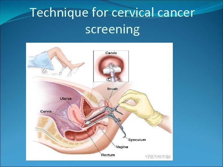 Technique for cervical cancer screening 