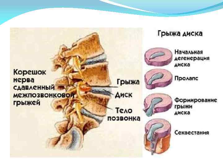 Импланты позвоночника поясничного отдела фото