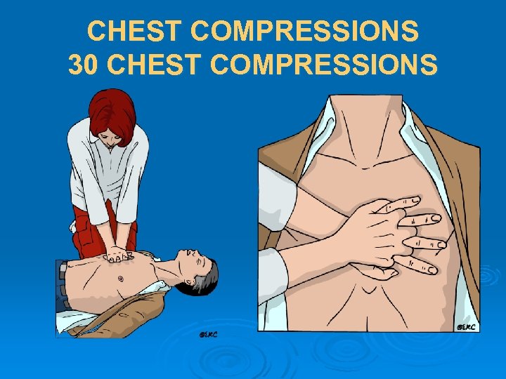 CHEST COMPRESSIONS 30 CHEST COMPRESSIONS 